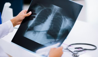 Ark Ai Boosts Chest X Ray Accuracy In Global Health Push
